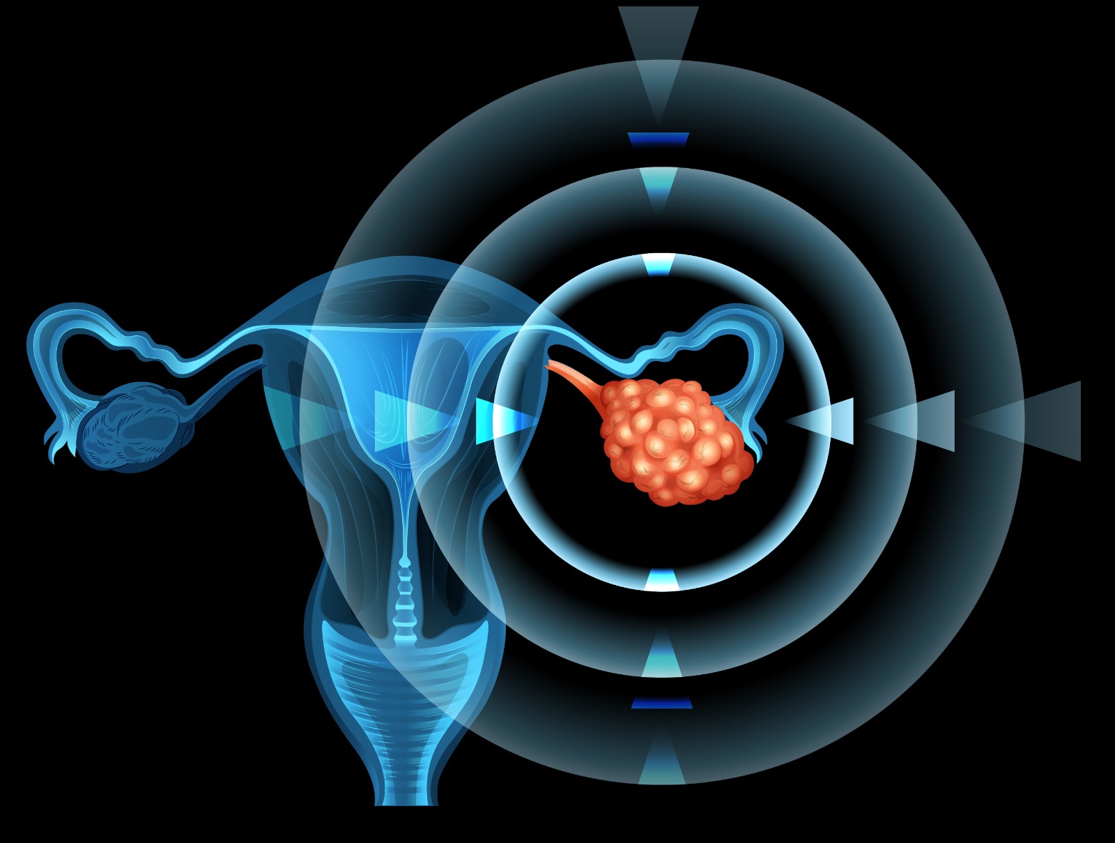 Dia Mundial do Câncer de Ovário: 1 a cada 4 mulheres com câncer de ovário apresenta mutação hereditária