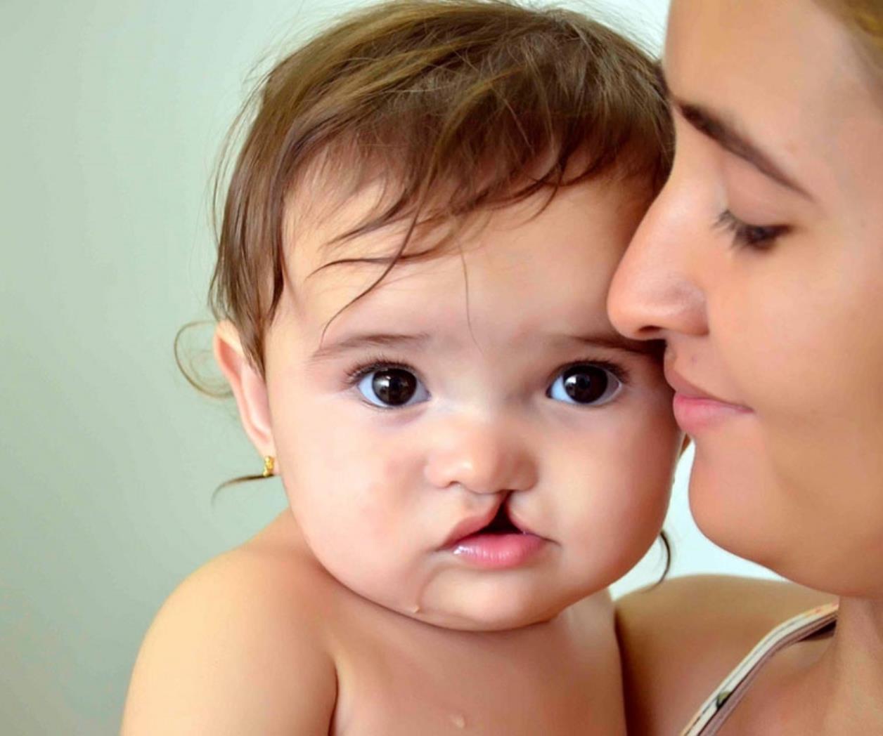 Como cuidar de um bebê com lábio leporino?