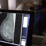 Ministério da Saúde amplia acesso à mamografia a partir dos 40 anos